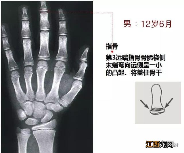 tw3骨龄对照表 骨龄对照表