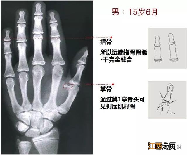 tw3骨龄对照表 骨龄对照表