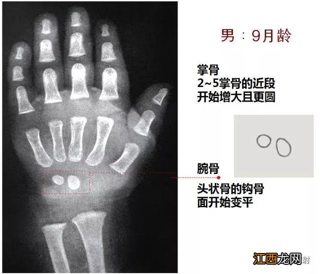 tw3骨龄对照表 骨龄对照表