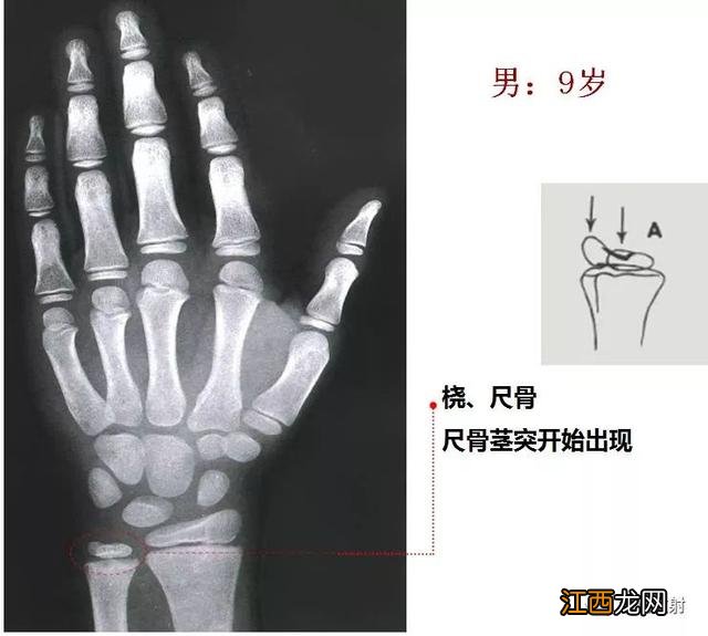 tw3骨龄对照表 骨龄对照表