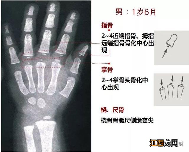 tw3骨龄对照表 骨龄对照表