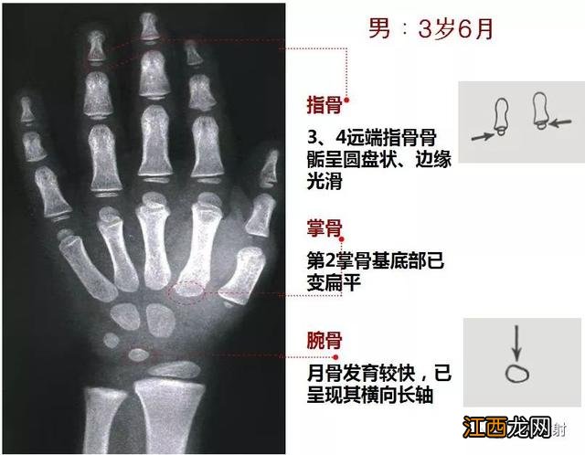 tw3骨龄对照表 骨龄对照表