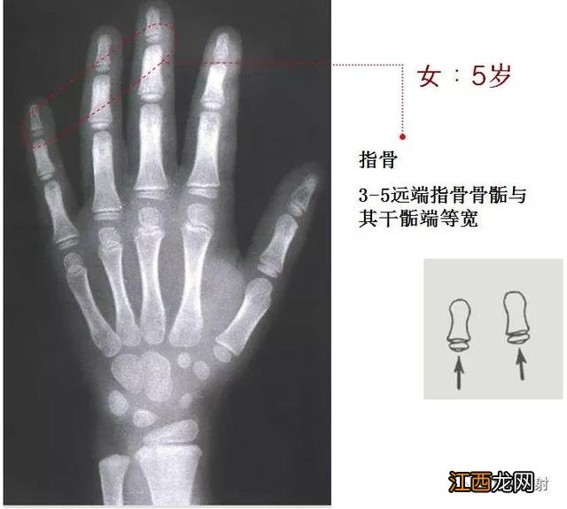 tw3骨龄对照表 骨龄对照表