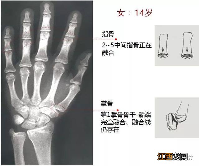 tw3骨龄对照表 骨龄对照表