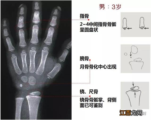 tw3骨龄对照表 骨龄对照表