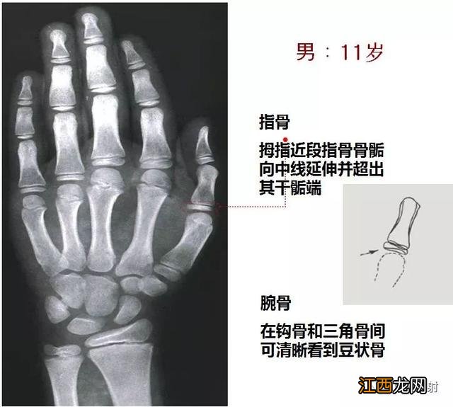 tw3骨龄对照表 骨龄对照表