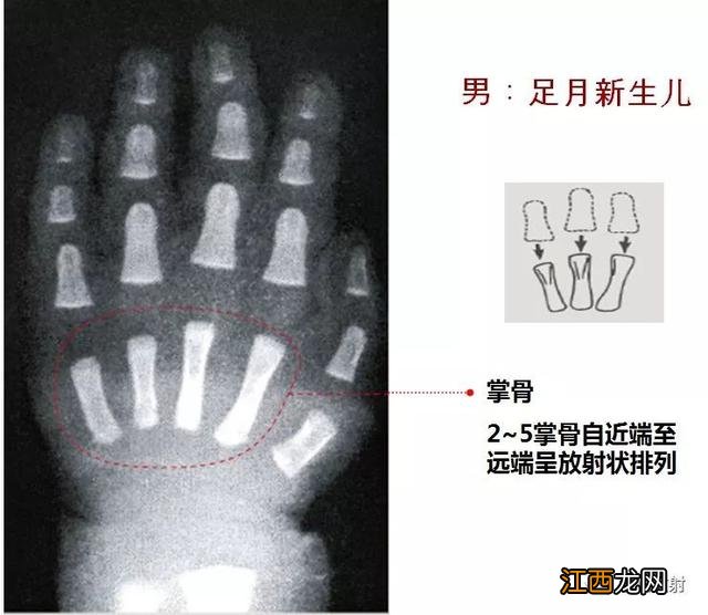 tw3骨龄对照表 骨龄对照表