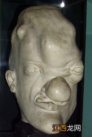 梅毒早期图片 发生 梅毒早期图片