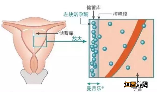 曼月乐环的作用与功效子宫腺肌病 曼月乐环的作用与功效