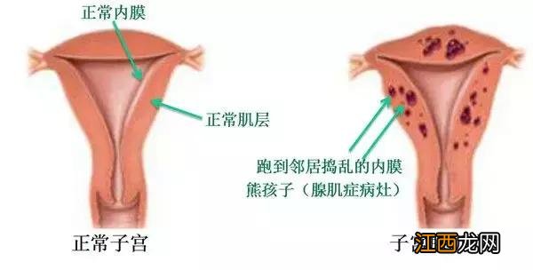 曼月乐环的作用与功效子宫腺肌病 曼月乐环的作用与功效