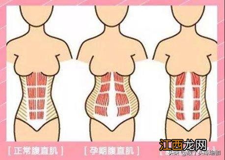 腹直肌分离如何修复