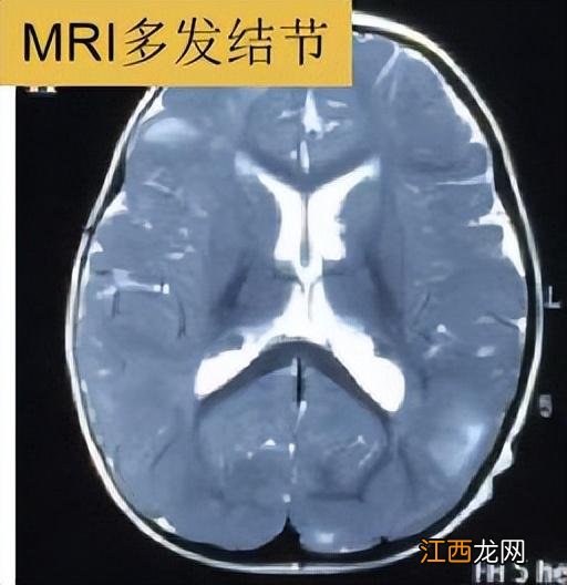 小孩皮肤有白块 小孩皮肤出现白块