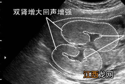 左右肾盂分离是男孩还是女孩 肾盂分离是男孩还是女孩