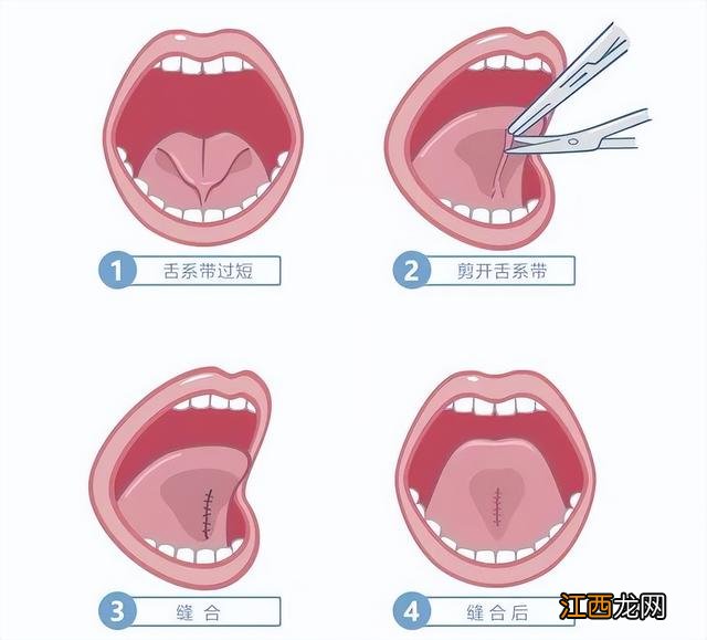 舌系带矫正术最佳年龄 舌系带矫正术