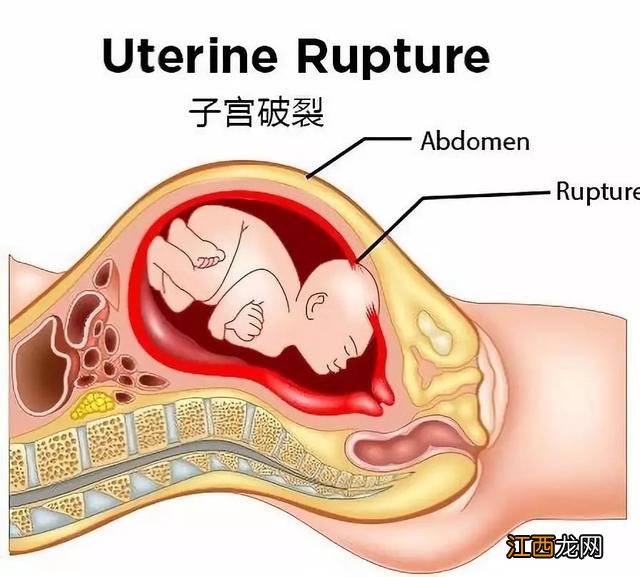 子宫憩室的症状会出现在很多年以后吗 子宫憩室的症状