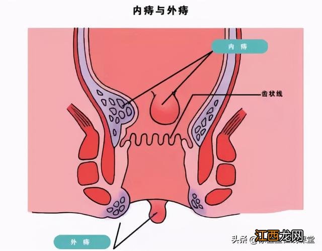 甲硝唑片治疗痔疮水肿吗 甲硝唑片可以治疗痔疮