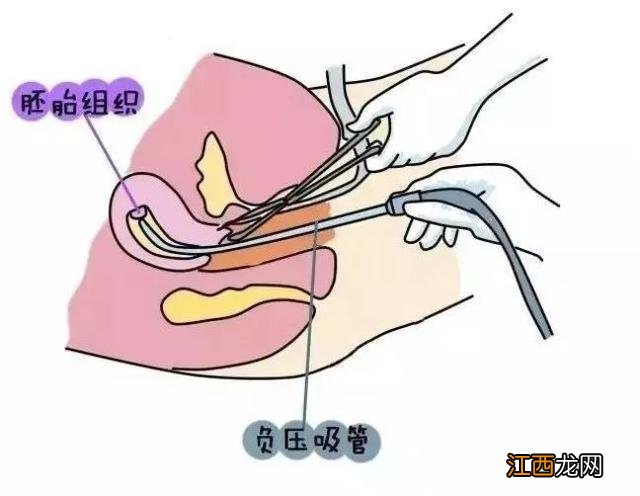 药流的整个过程需要多长时间 药流的整个过程痛苦吗