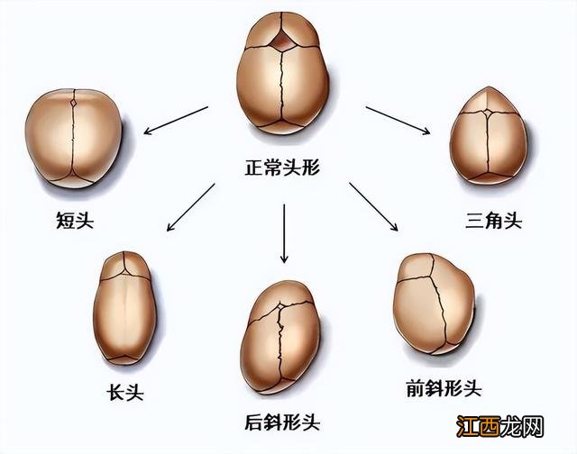 婴儿头型舟状头图片 婴儿头型