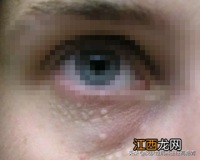 扁平疣和脂肪粒区别图怎样去除脂肪粒 扁平疣和脂肪粒区别图