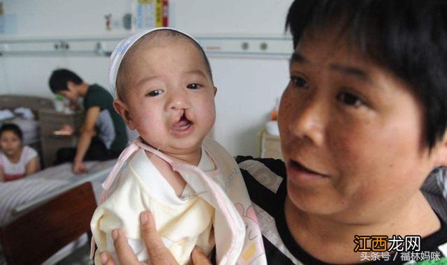 先天性唇腭裂是什么原因导致的 先天性唇腭裂