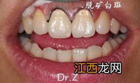 牙齿为什么会蛀掉呢 牙齿为什么会蛀掉