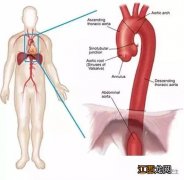 右位主动脉弓需要治疗吗 右位主动脉弓