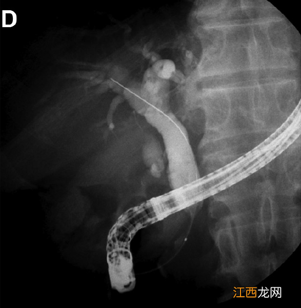 阻塞性黄疸的尿液颜色 阻塞性黄疸