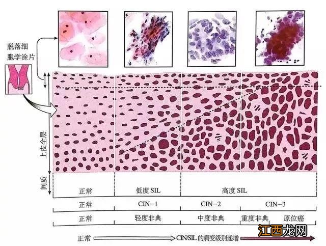 TCT检查结果有几种? tct检查结果有几种