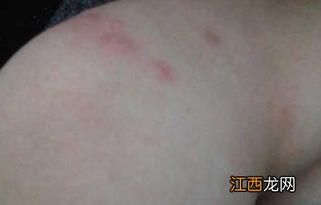 跳蚤咬了有啥症状 跳蚤咬了有什么症状