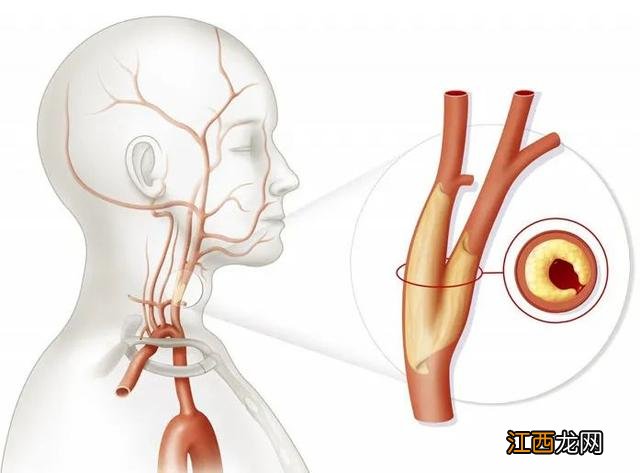 血管最容易发生堵塞的3个地方 血管堵塞最快的方法图解