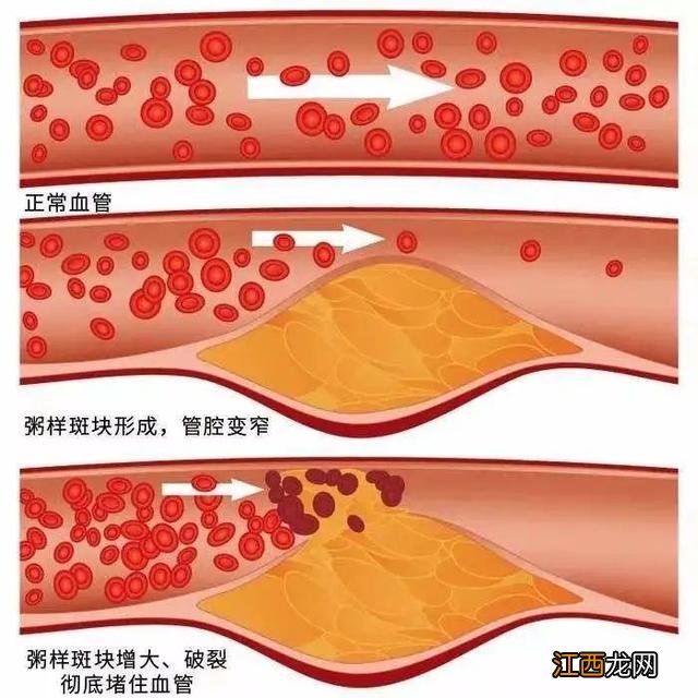 血管最容易发生堵塞的3个地方 血管堵塞最快的方法图解