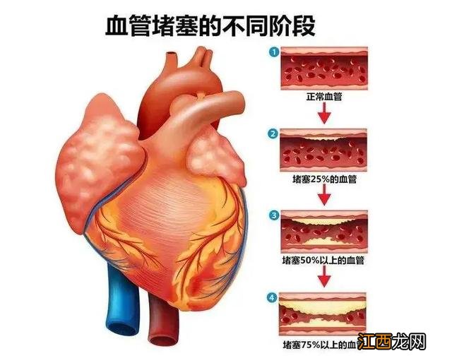 血管最容易发生堵塞的3个地方 血管堵塞最快的方法图解