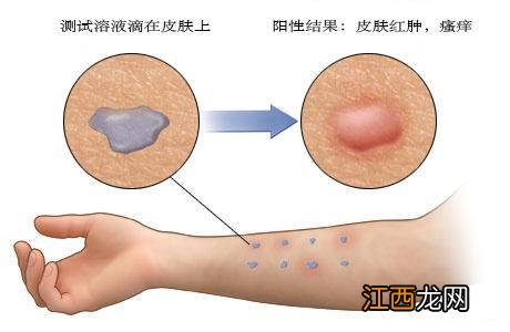 宝宝黑眼袋当心变应性鼻炎 小孩鼻炎可导致眼袋吗