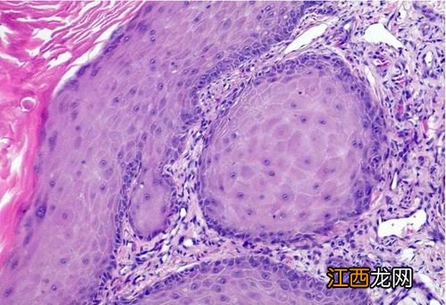 鳞状细胞是怎么回事
