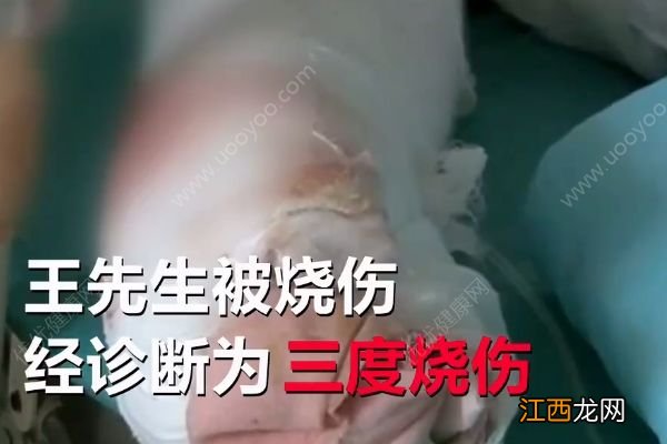 不慎引燃酒精桶，男子家中吃烧烤吃成三度烧伤