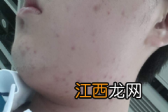 头发油腻解决方法有哪些？头发太油腻该怎么办才好？