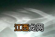 锁骨骨折疼多长时间能好 锁骨骨折两个月恢复吗