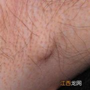 男性腋窝下有肿块是怎么回事