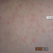 小腿有红斑不痒不痛是怎么回事