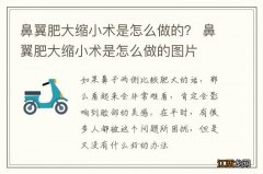 鼻翼肥大缩小术是怎么做的？ 鼻翼肥大缩小术是怎么做的图片