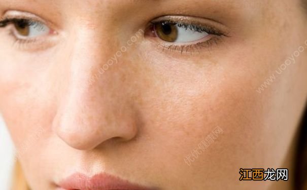 产后如何防止长雀斑？产后如何去除雀斑？