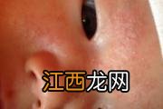 宝宝湿疹起皮之后怎么处理