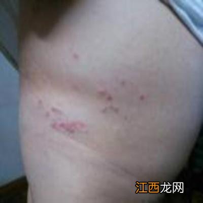 荨麻疹能自愈吗