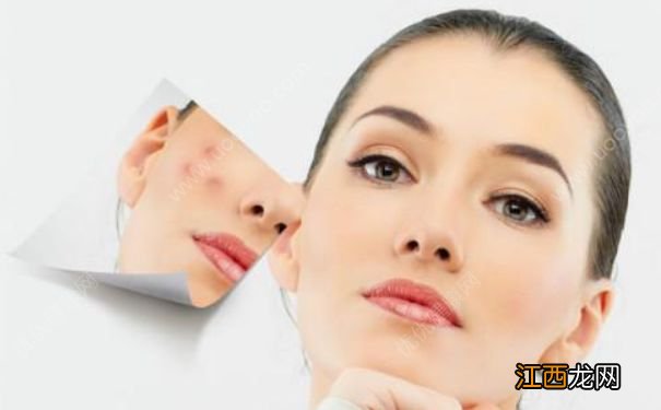 怎样去除痘印？如何有效去除痘印？