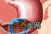 胃溃疡要怎样治疗 偏方食疗帮你养胃