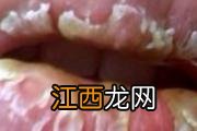 阴囊瘙痒怎么止痒