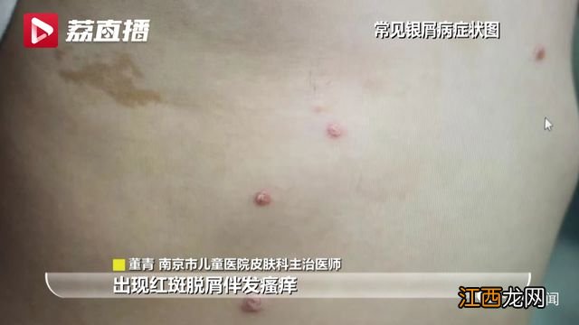 11岁女孩皮肤被涂“敌百虫”，确诊中毒！家长：本是为了治病