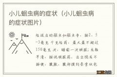 小儿蛔虫病的症状图片 小儿蛔虫病的症状