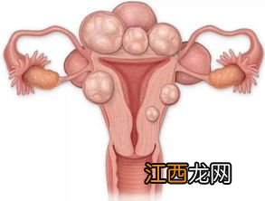 平安福子宫肌瘤怎么赔?