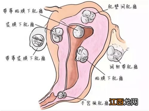 子宫肌瘤术后复查能用门诊医疗险报销吗？